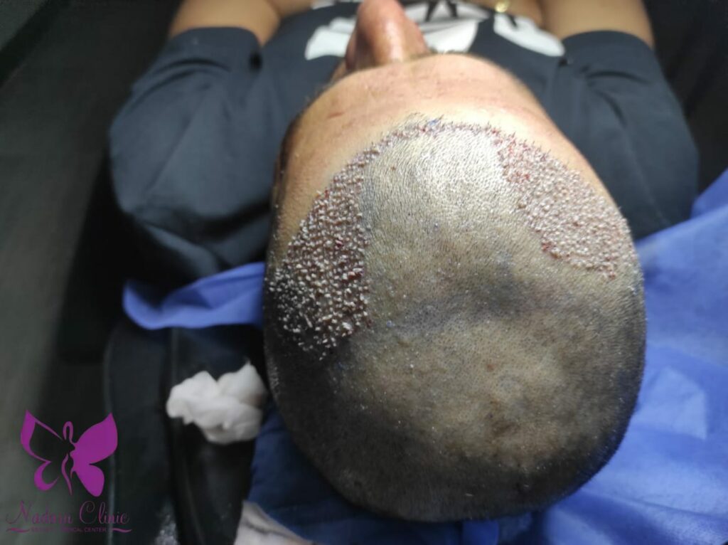 زراعة الشعر لفراغ السبعتين